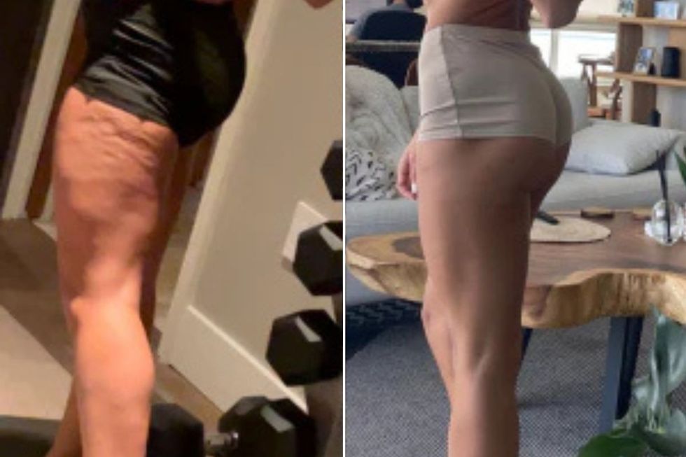 MELISSA'S THIGHS BEFORE AND AFTER