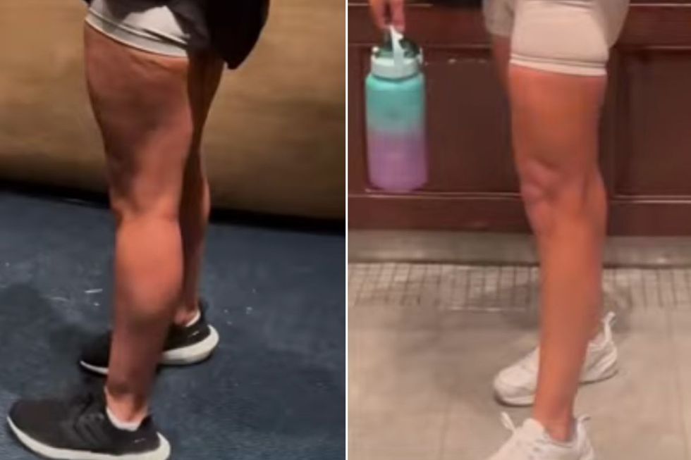 MELISSA'S THIGHS BEFORE AND AFTER