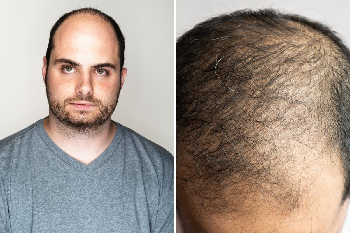 Men struggling with hair loss
