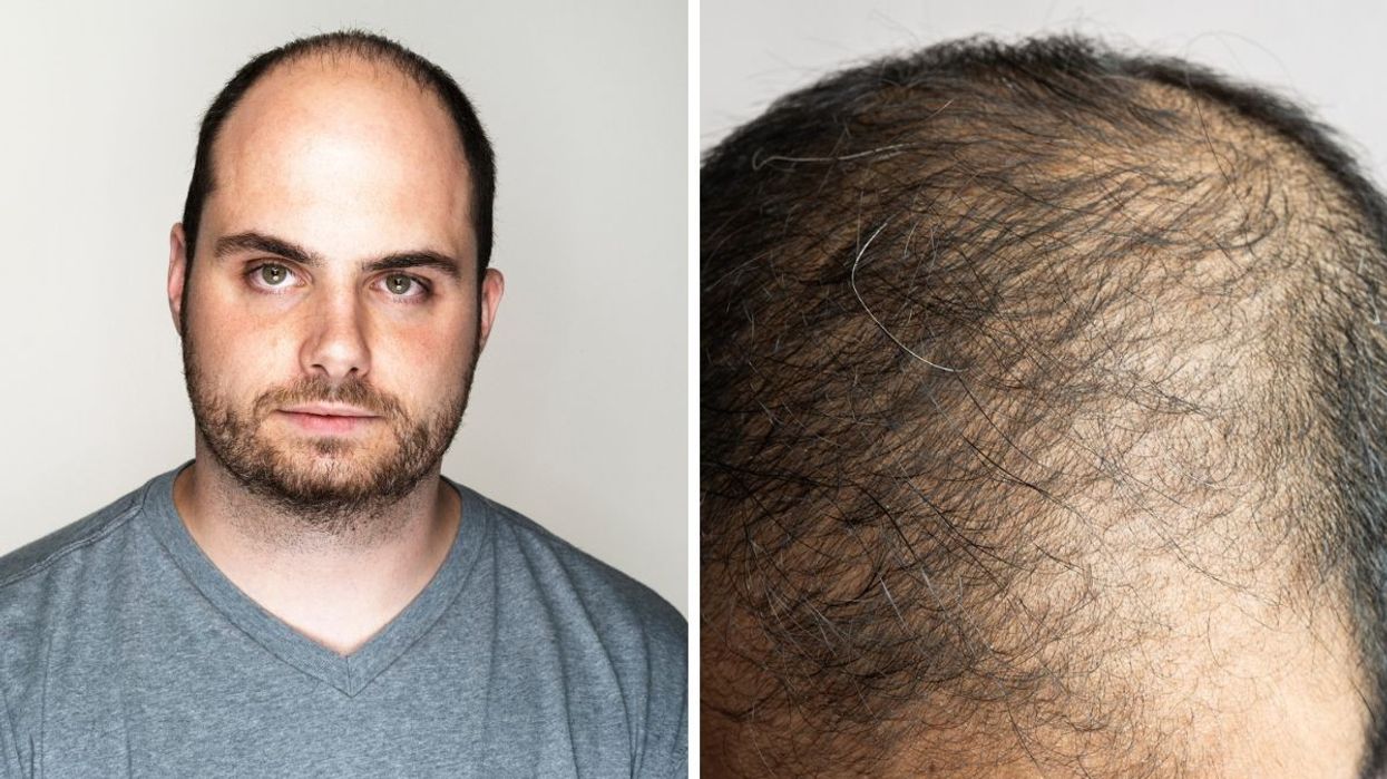 Men struggling with hair loss