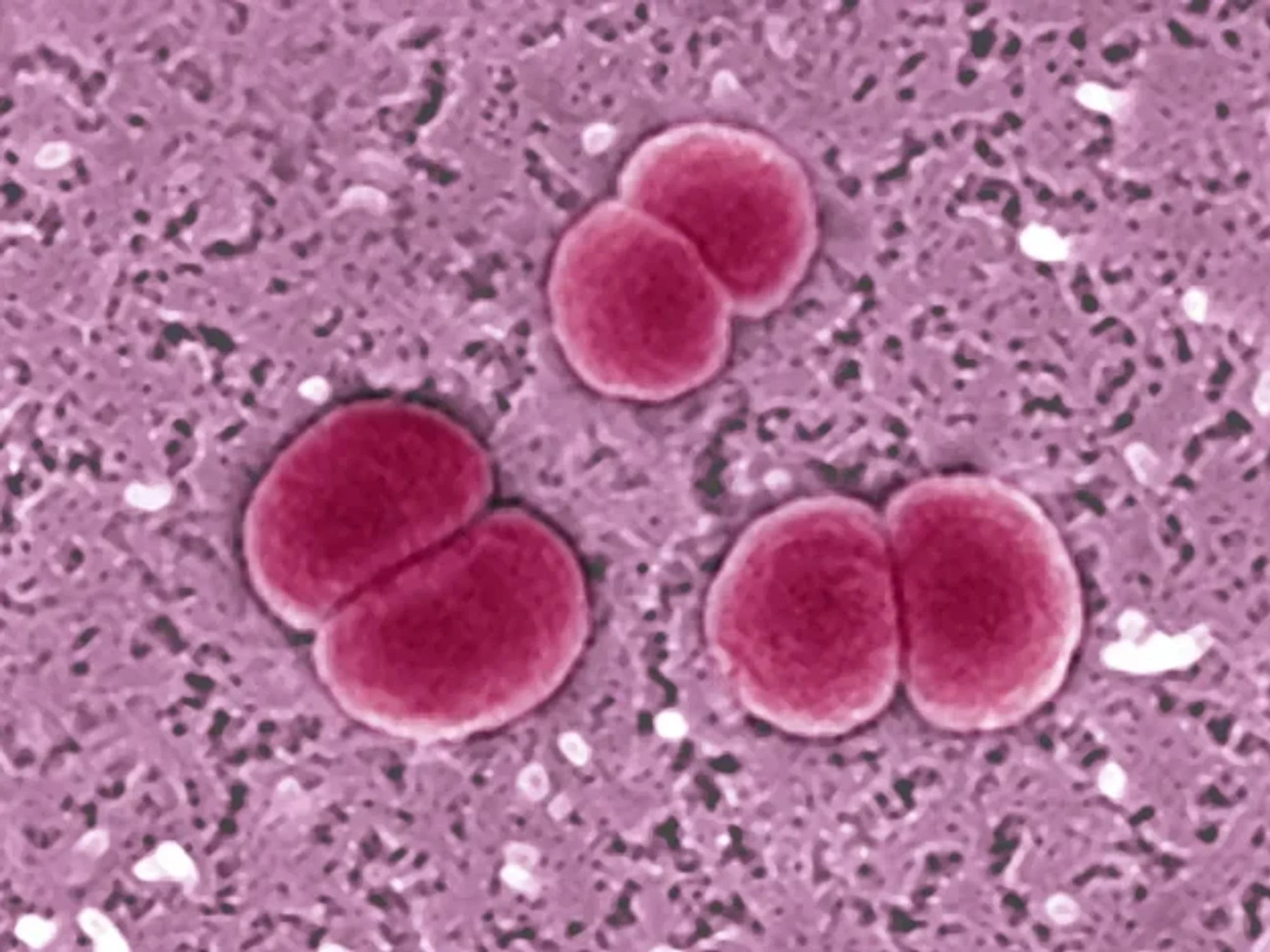 MENINGITIS