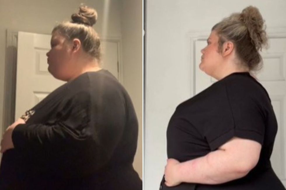 Mental gastric before and after transformation