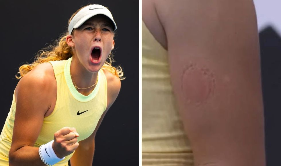 Mirra Andreeva had a huge bite mark on her arm