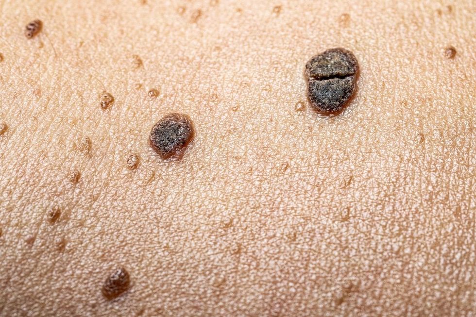 MOLES ON SKIN