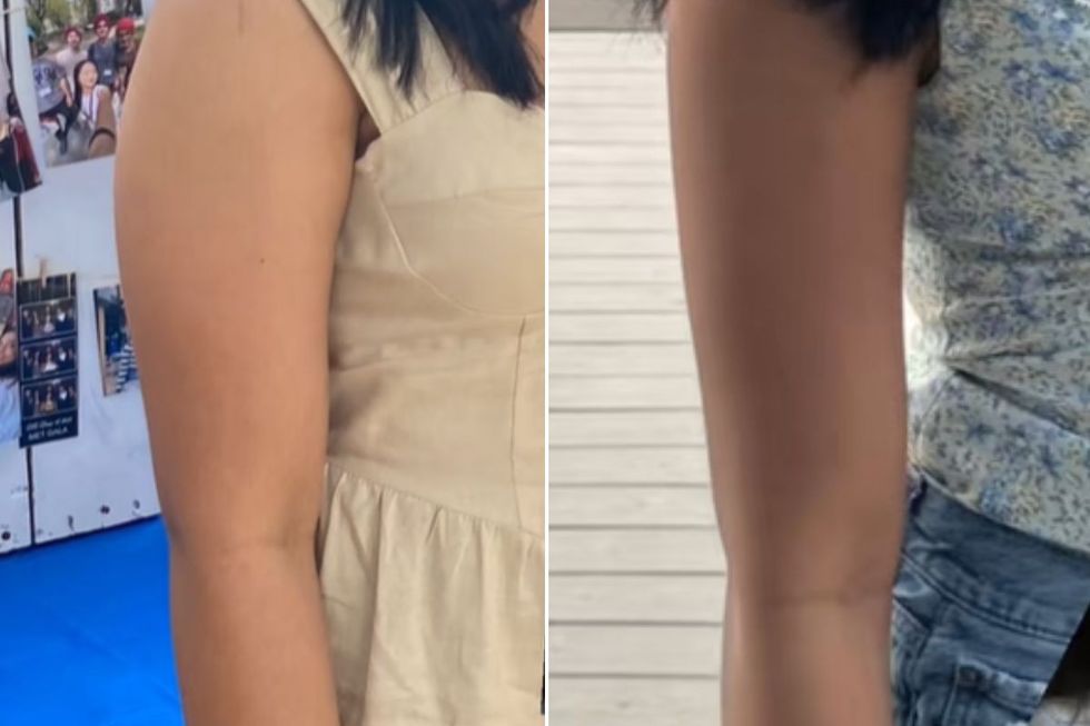 Molli before and after arm transformation
