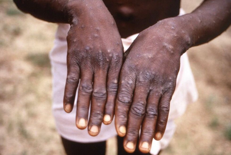 Monkeypox rashes