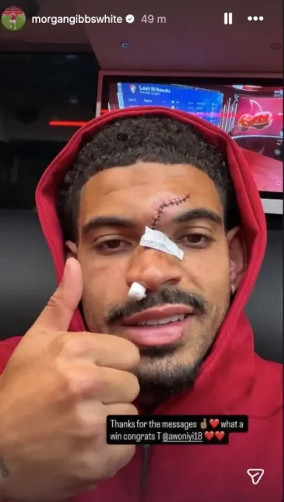 Morgan Gibbs-White has revealed the extent of his facial wounds following a brutal collision with Chelsea goalkeeper Robert Sanchez during Nottingham Forest's impressive 3-1 triumph at Stamford Bridge