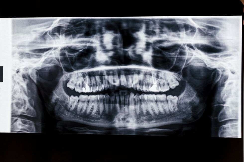 ESCANEAMENTO DE CÂNCER ORAL