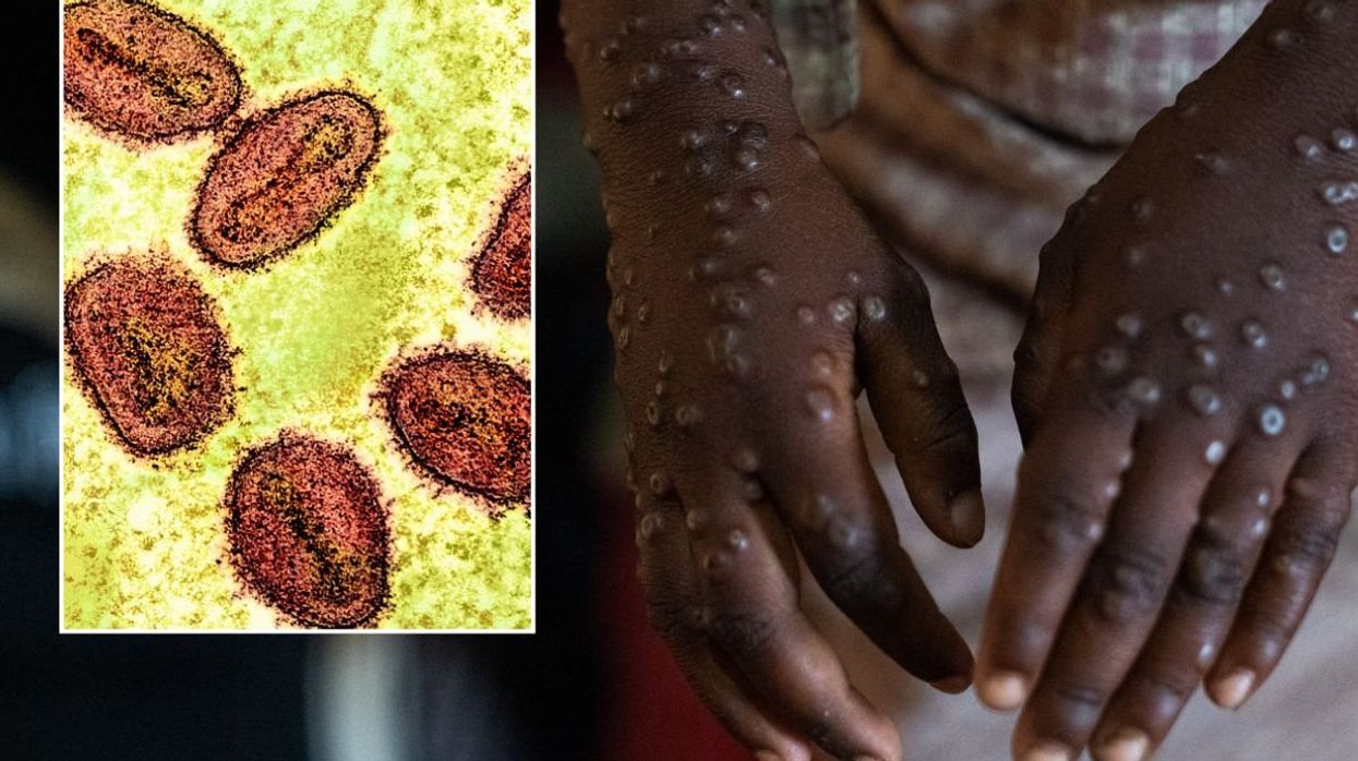 MPOX PATIENT AND MPOX UNDER MICROSCOPE