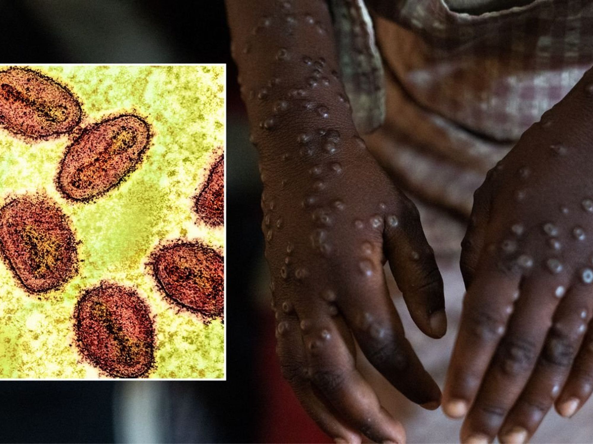 MPOX PATIENT AND MPOX UNDER MICROSCOPE