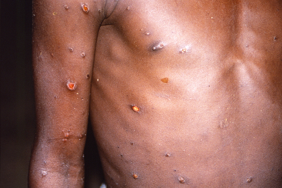 Mpox rash