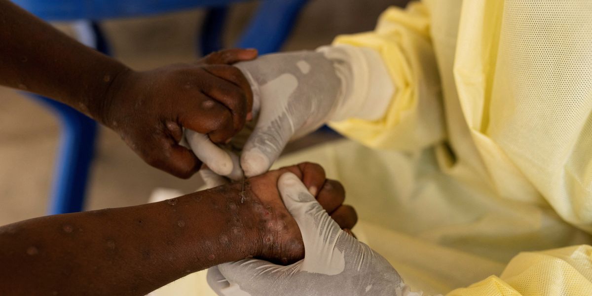 NextImg:European country confirms first case of more contagious mpox found outside Africa