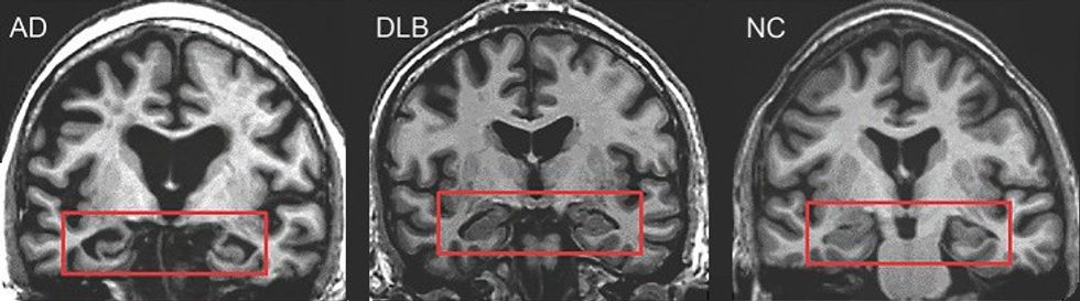 MRI of brain showing hippocampus atrophy (red rectangles), more prominent in Alzheimer's disease