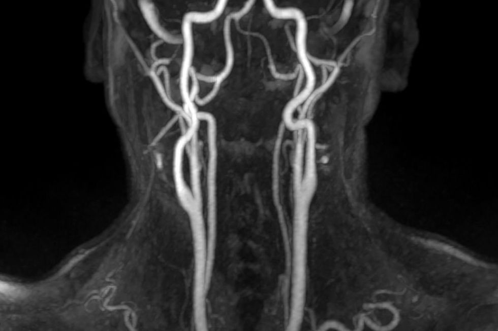 NECK AND BRAIN MRI SCAN
