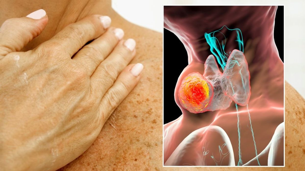 NECK PAIN AND CANCER ILLUSTRATION