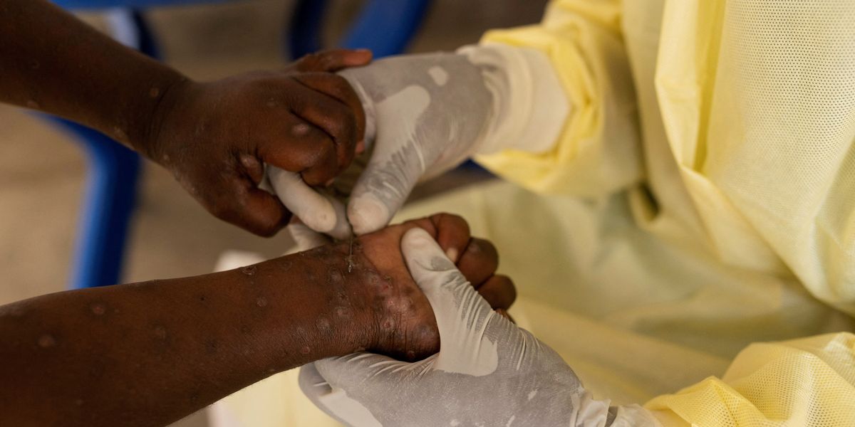 NextImg:Mpox creeps closer to Britain as new variant detected for first time in France