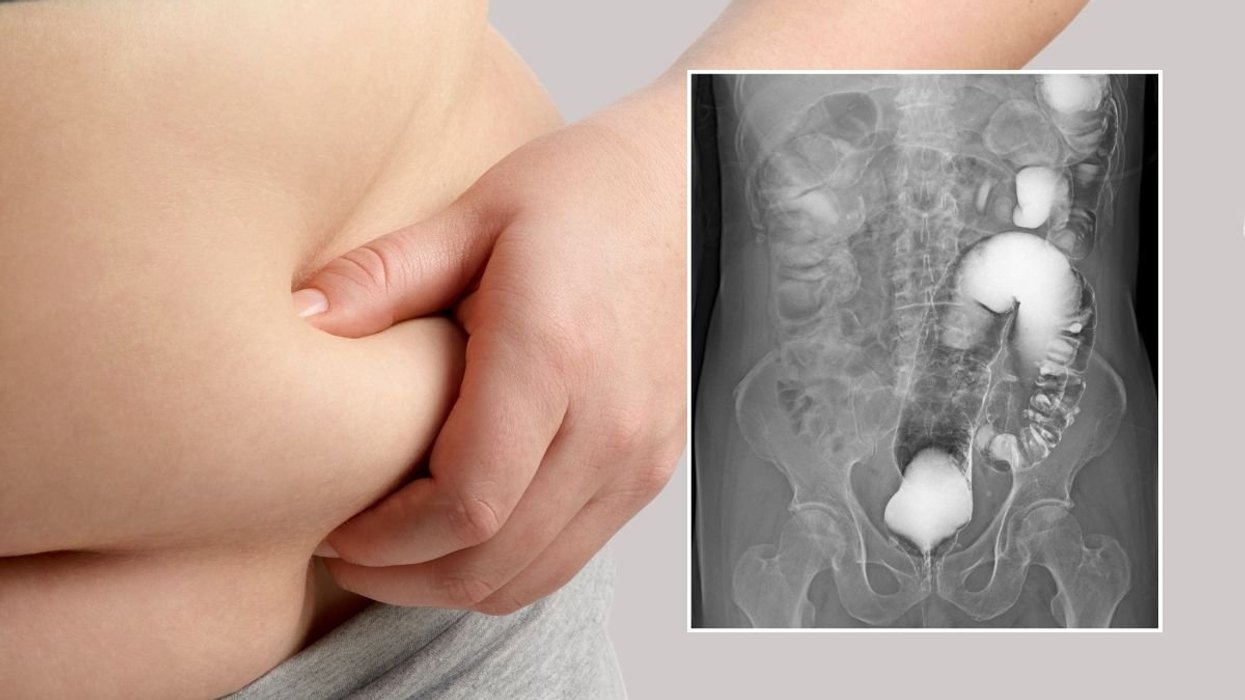 obese person and bowel scan