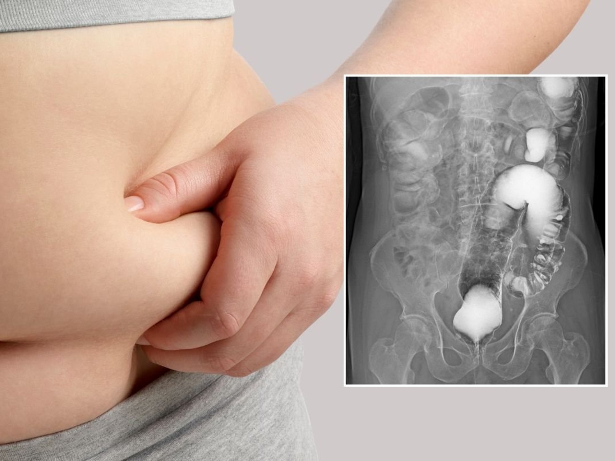 obese person and bowel scan