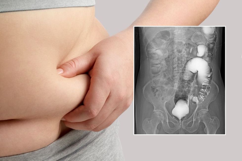 obese person and bowel scan