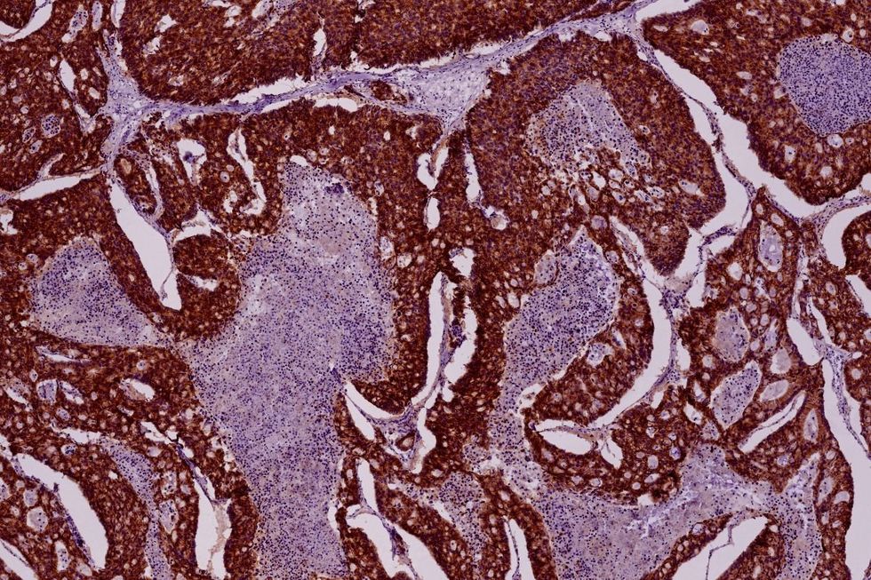 PANCREATIC CANCER SCAN