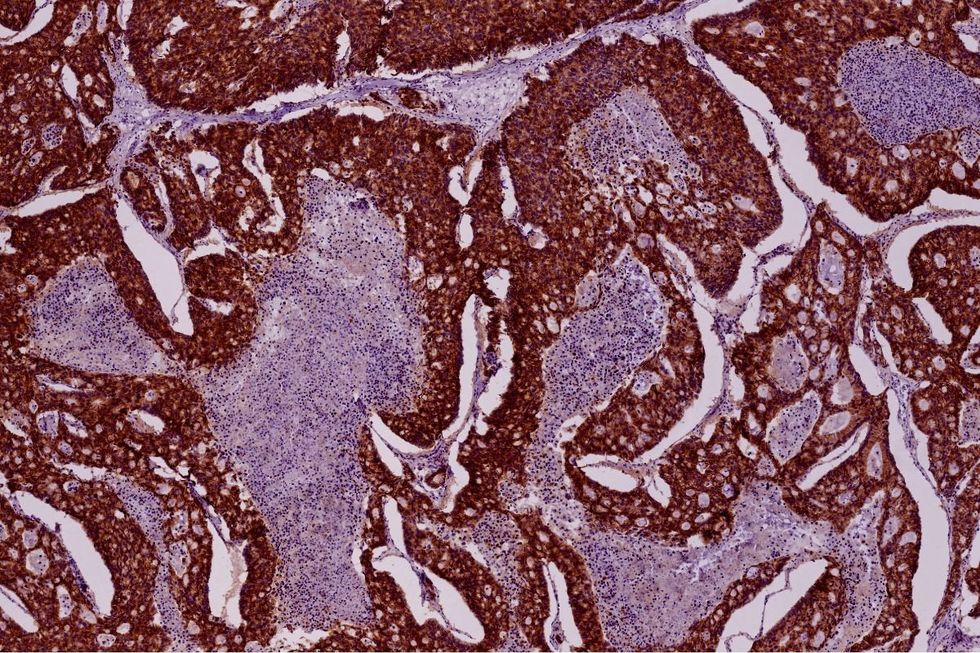 Pancreatic cancer tissue