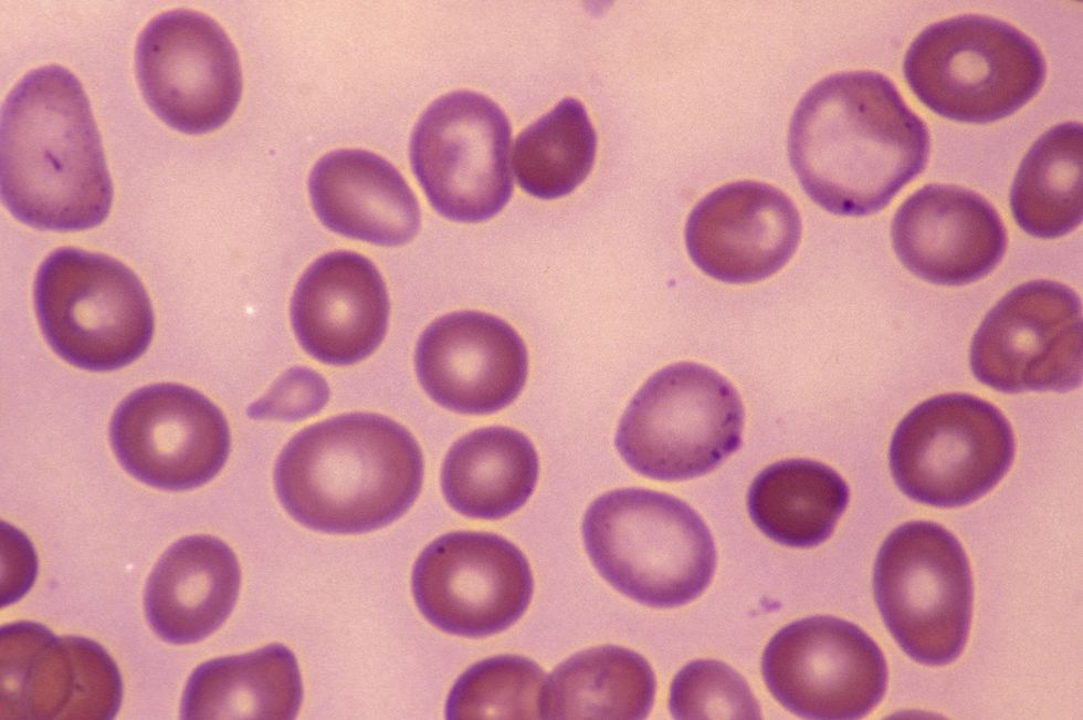 Pernicious anaemia showing abnormal and variable red blood cells