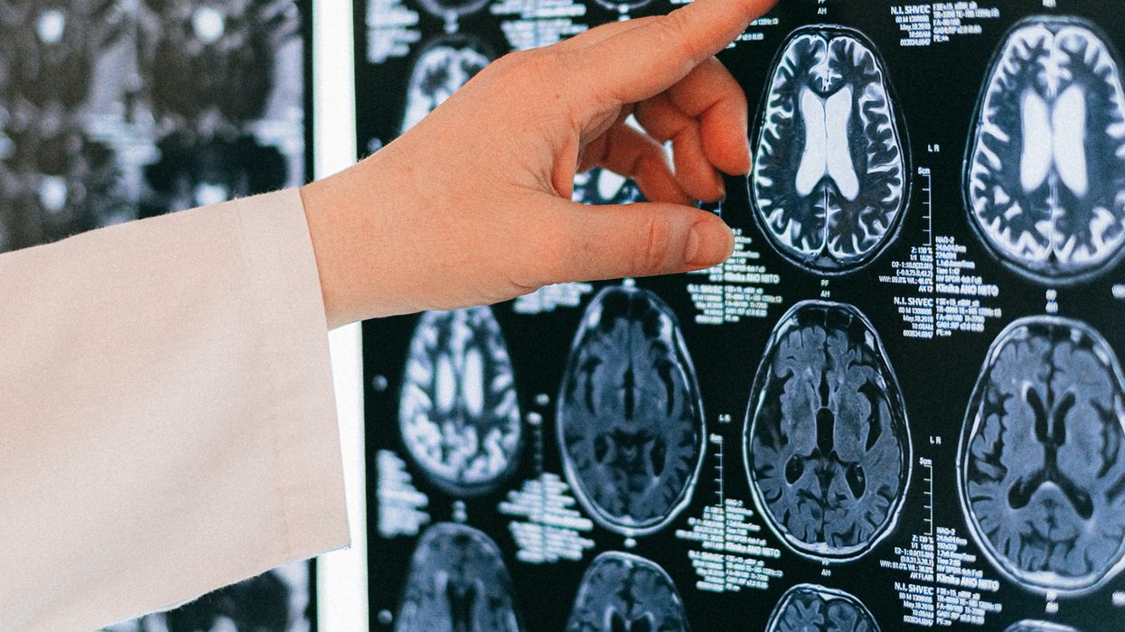 Person pointing to scan of brain