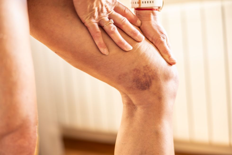person with blood clot in leg