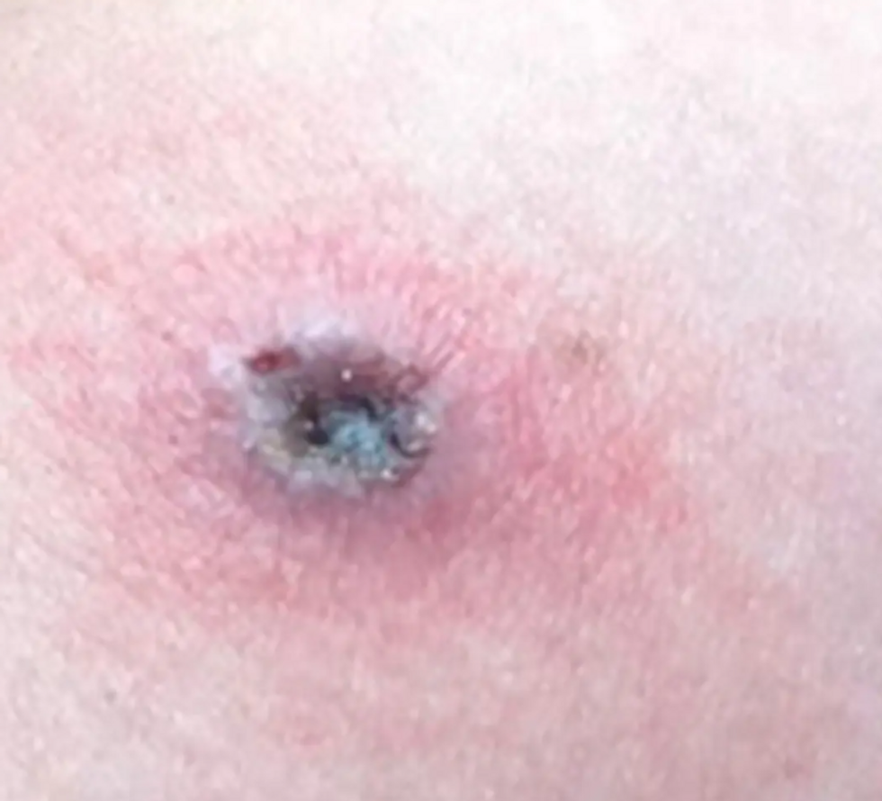 Picture of a skin lesion