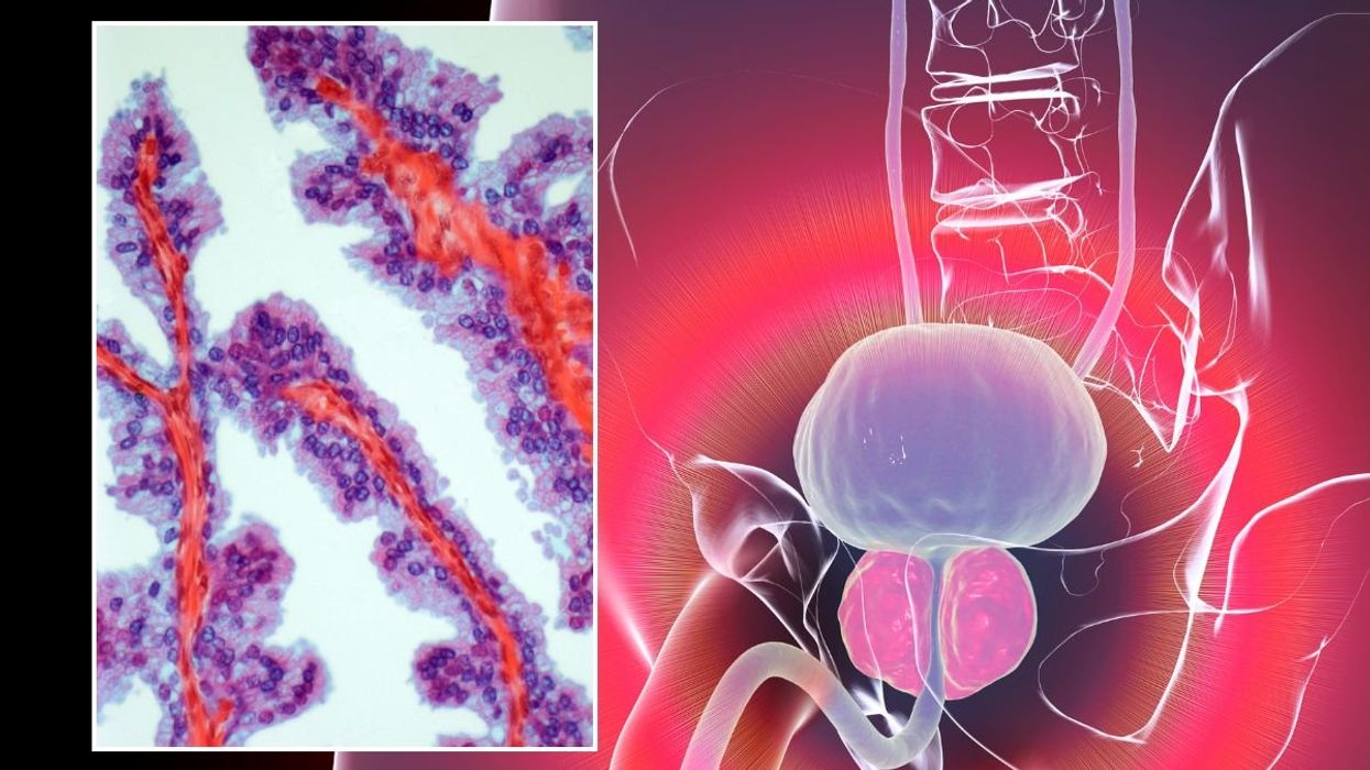 PROSTATE CANCER ILLUSTRATION