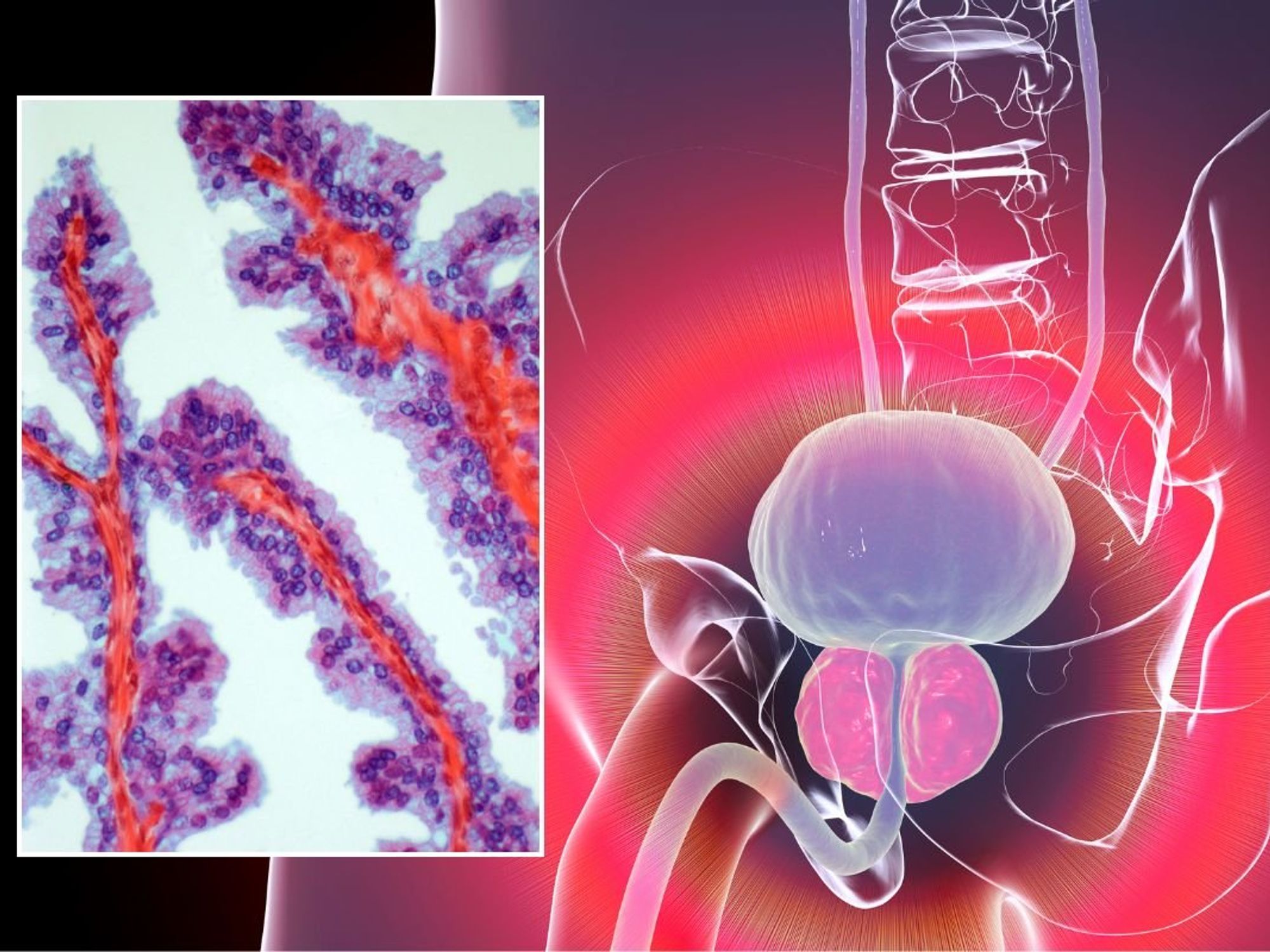 PROSTATE CANCER ILLUSTRATION