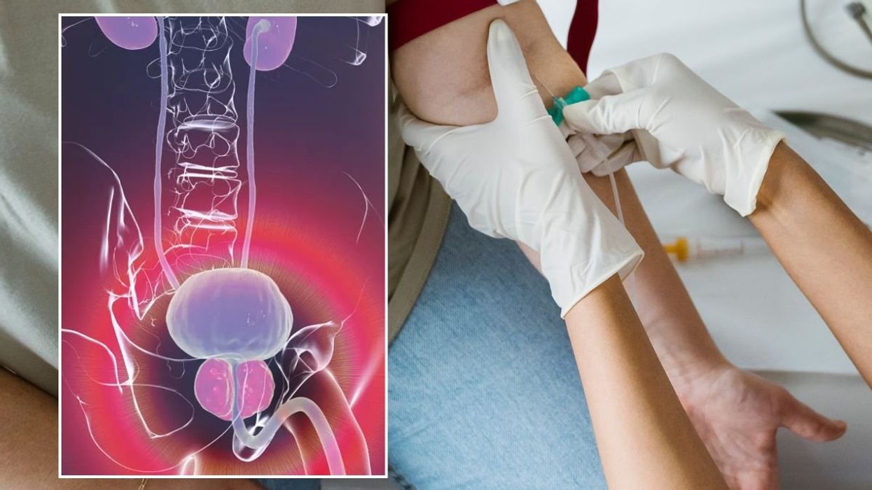 PROSTATE CANCER ILLUSTRATION