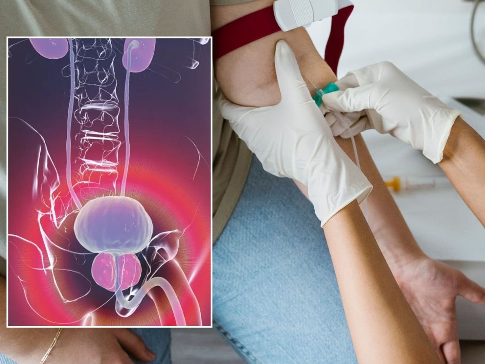 PROSTATE CANCER ILLUSTRATION