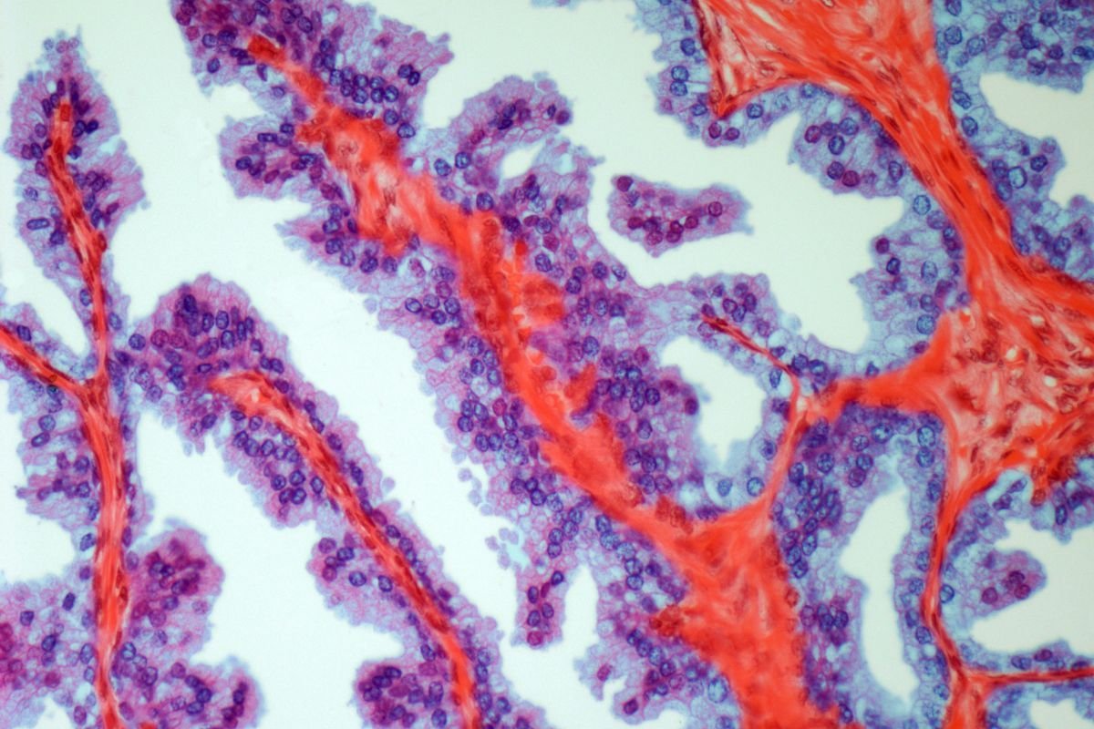 PROSTATE CANCER MICROGRAPH