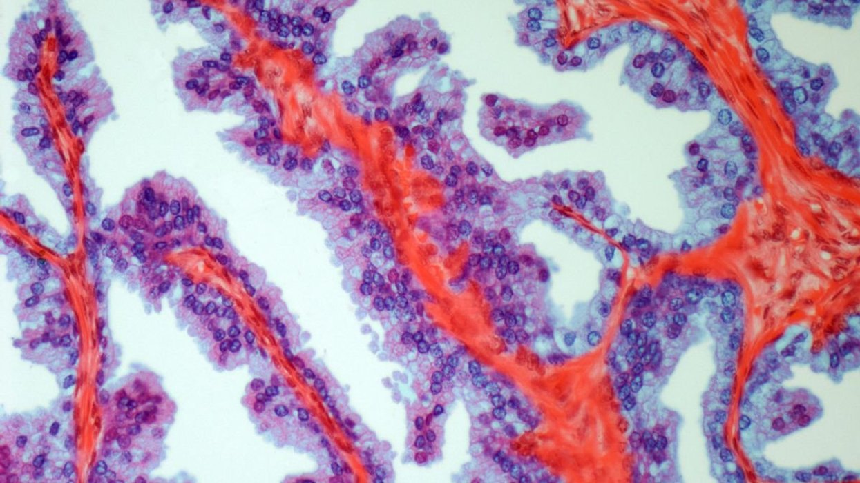 PROSTATE CANCER MICROGRAPH