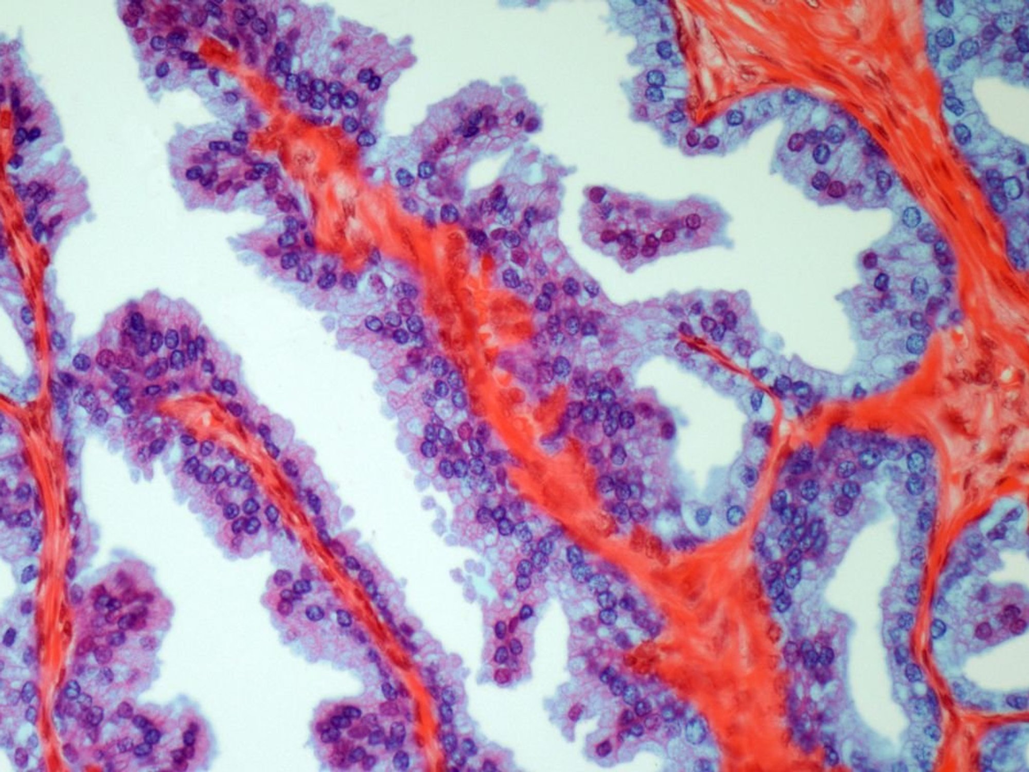 PROSTATE CANCER MICROGRAPH