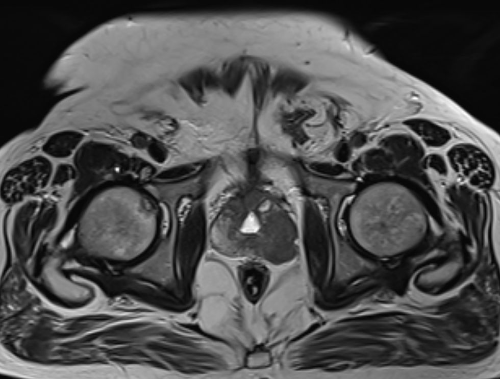 Prostate cancer scan