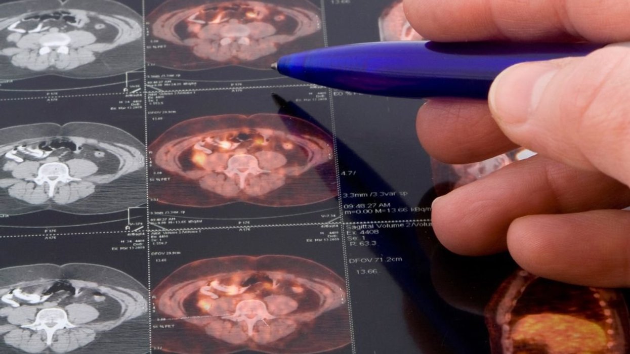 PROSTATE CANCER SCAN