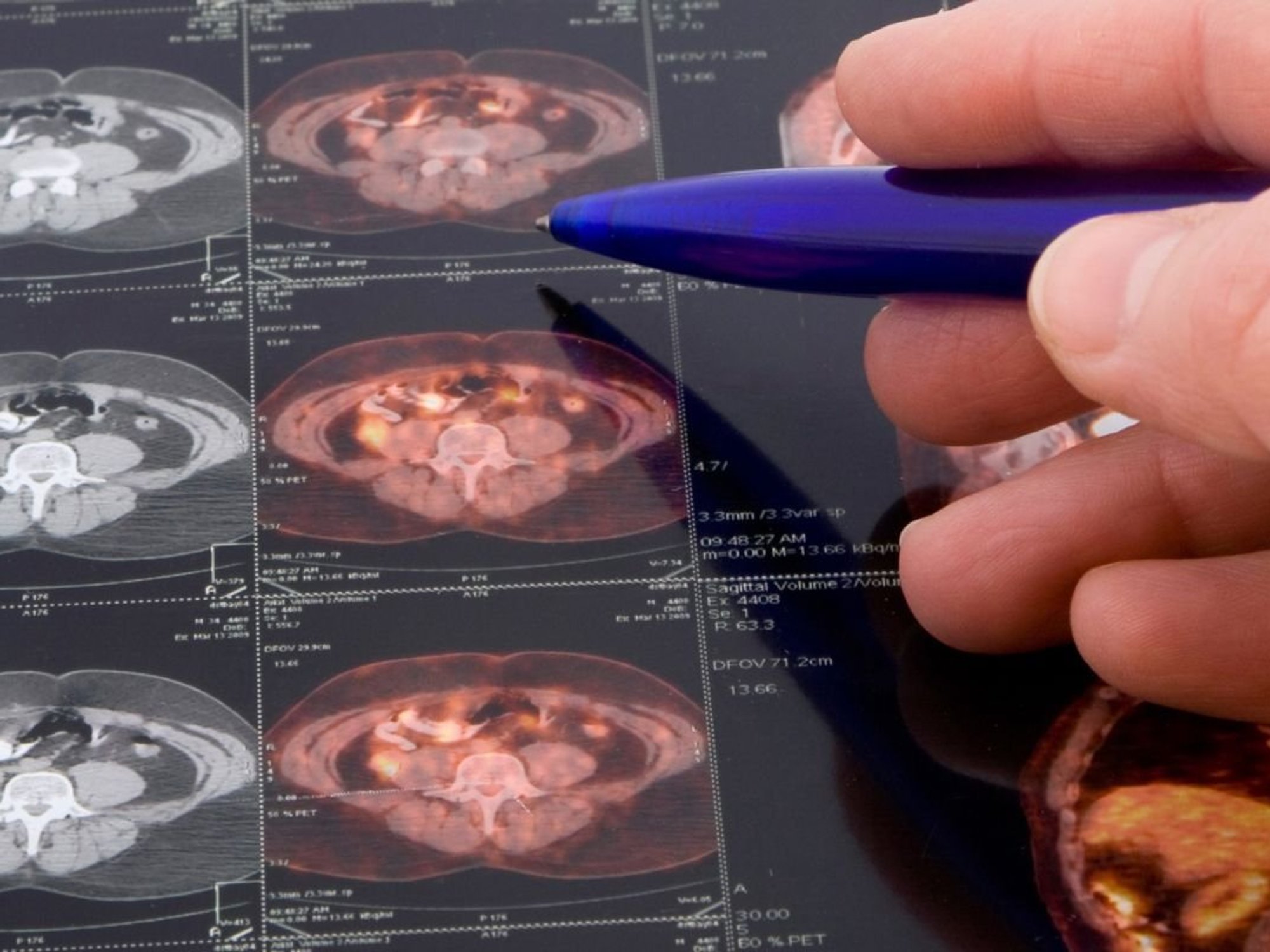 PROSTATE CANCER SCAN