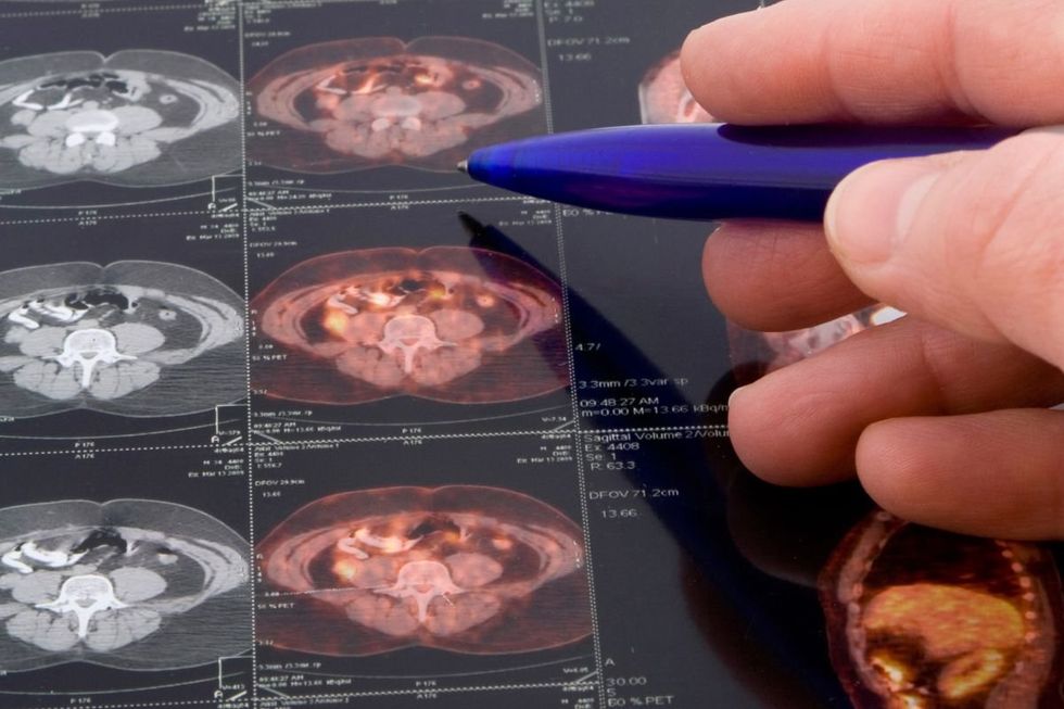 PROSTATE CANCER SCAN