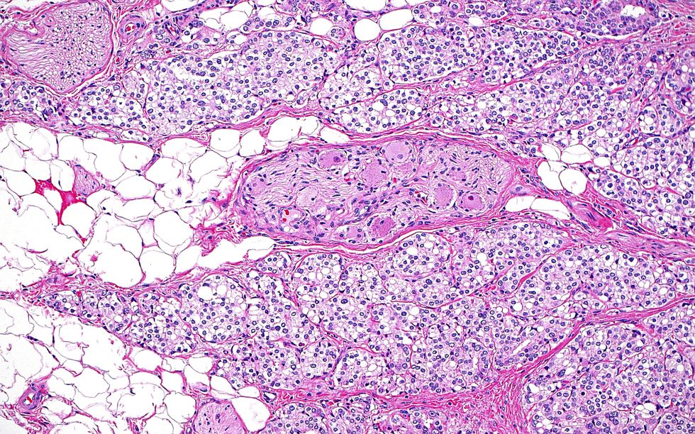 PROSTATE CANCER TISSUE
