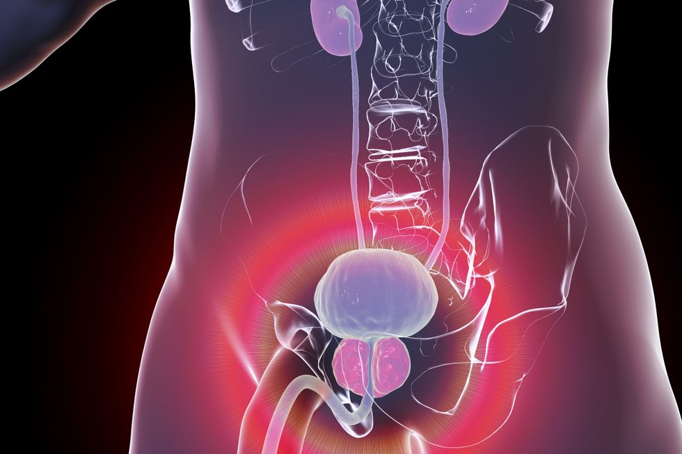 PROSTATE TUMOUR ILLUSTRATION