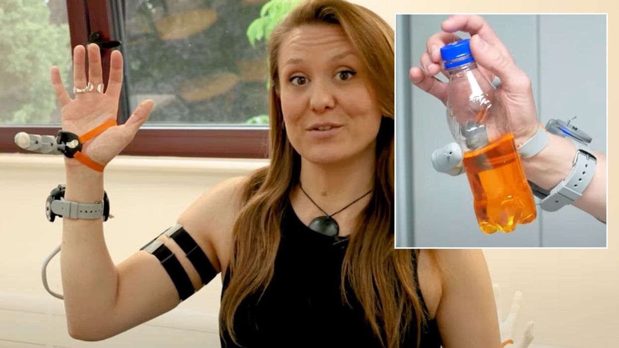 Prosthetic thumb with inventor Dani Clode