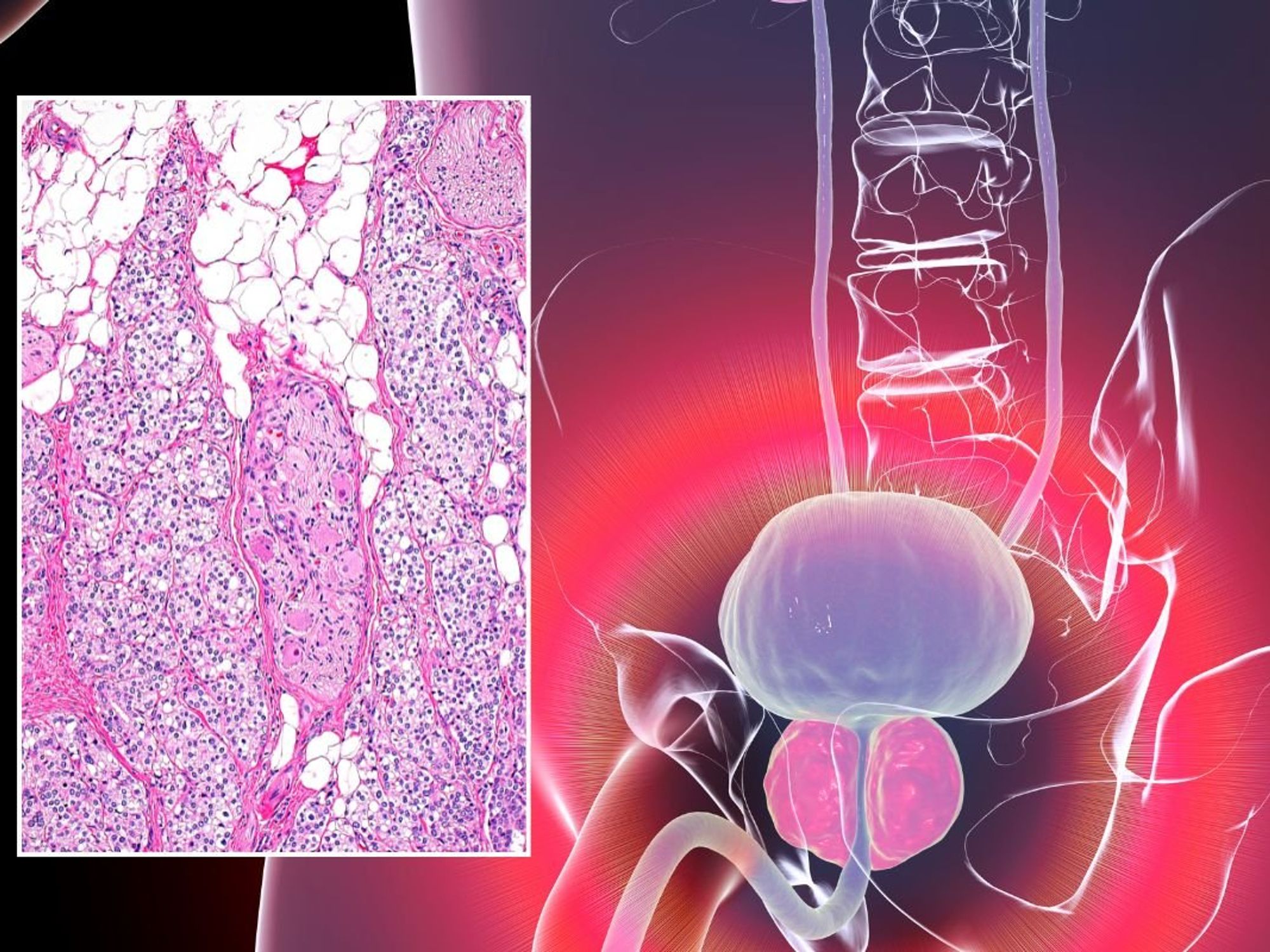 Prostrate cancer