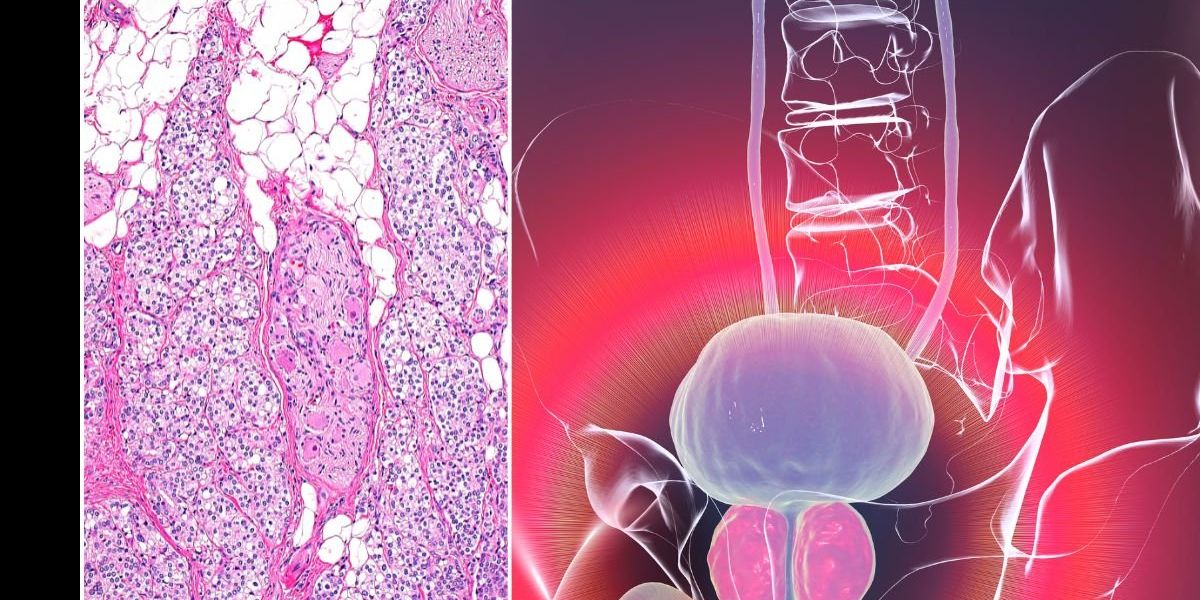 NextImg:Hope for men with advanced prostate cancer as two-pronged treatment slashes tumour growth sixfold in 10 days