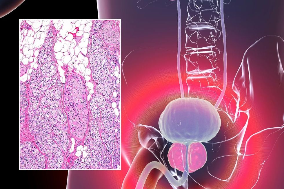 Prostrate cancer