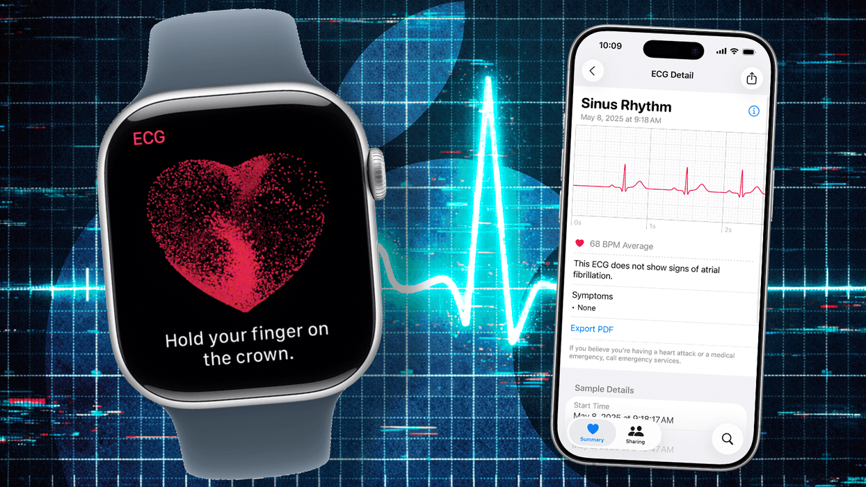 Giving an Apple Watch to patients with heart condition could reduce NHS burden, study shows