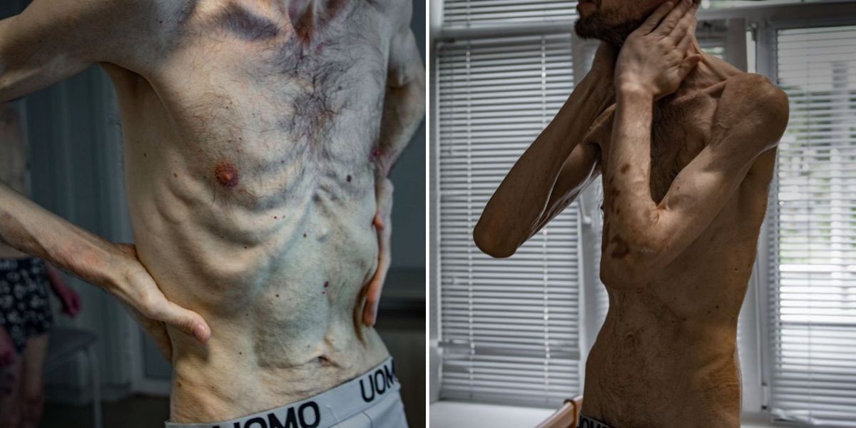 NextImg:Horrific pictures reveal effects of Putin's 'Nazi-like' detention camps as prisoner released after 2 years in Russian captivity