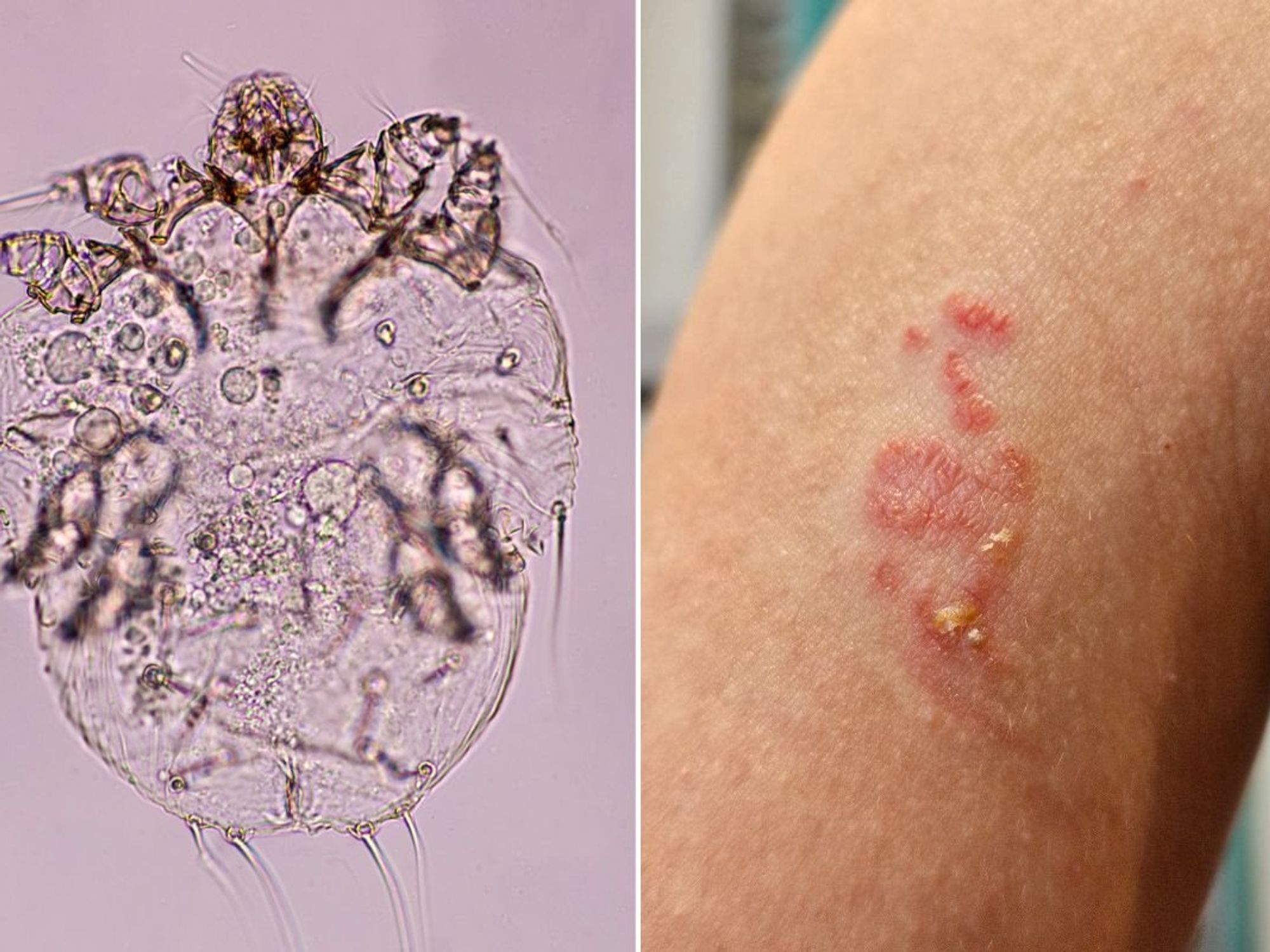 scabies mite