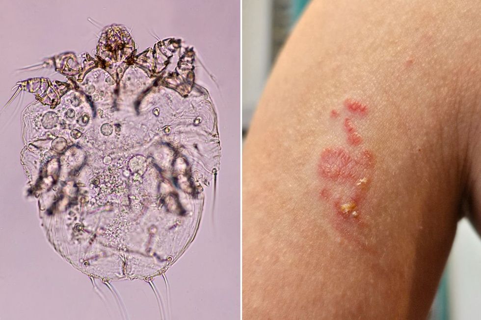 scabies mite